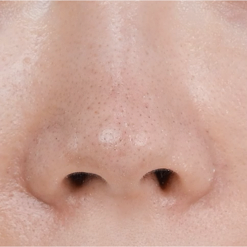 Двухступенчатая маска от чёрных точек Medi-Peel Extra Super 9 Plus Blackhead Out Nose Pack